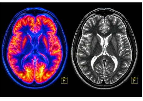 ربط العلماء بين الإفراط في مشاهدة التلفاز وتغيرات الدماغ بعد عقود